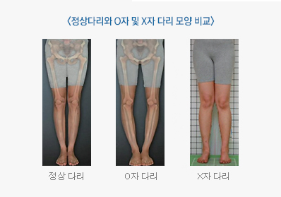 정상다리와 O자 및 X자 다리 모양을 비교한 이미지