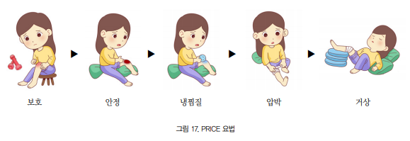 그림 17. PRICE요법 왼쪽부터 앉아서 무릎을 살피는 여자, 앉아서 상처부위를 보는 여자, 앉아서 무릎에 얼음찜질을 하는 여자, 앉아서 붕대로 무릎을 감고있는 여자, 앉아서 높은 물건위에 다친무릎의 발을 올려놓는 여자의 이미지이며, 각각 보호, 안정,냉찜질,압박,거상이라 적힌 이미지.