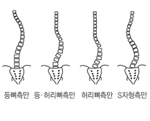 척추측만증 자세 참고 이미지