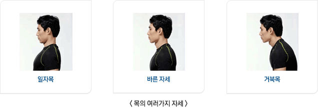 목의 여러가지 자세를 보여주는 이미지: 총 세장의 이미지 중 첫번째는 일자목 남성의 이미지, 두번째는 바른 자세 남성의 이미지, 세번째는 거북목 남성의 이미지이다.
